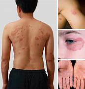 Image result for Fungal Infection On Body Becomes Black