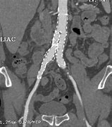 Image result for CT Angiogram Abdomen