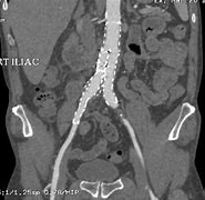 Image result for CT Angiogram Abdomen