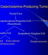 Image result for Pheochromocytoma Presentation