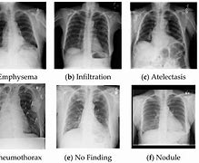 Image result for Chest X-Ray Lungs