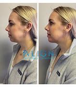 Image result for Chin Correction Filler