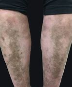 Image result for Dark Pigmentation On Legs