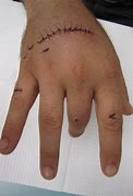 Image result for Extensor Tendons Dorsal Hand