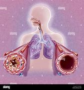 Image result for Asthma Painting