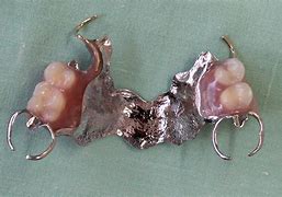 Image result for Partial Plate Dentures