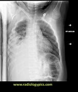 Image result for Right-Sided Empyema