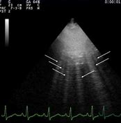 Image result for Lung Ultrasound B Lines Pulmonary Edema