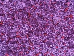 Image result for Neuropil Medulloblastoma