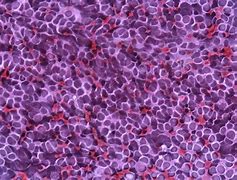 Image result for Medulloblastoma in Children