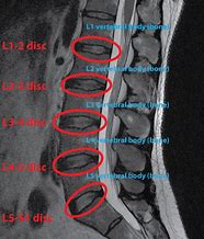 Image result for Lumbar Spine MRI 8Mm