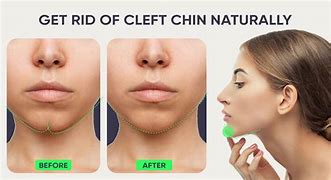 Image result for What Is Cleft Chin