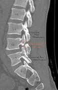 Image result for Pars Defect Lumbar Spine