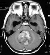 Image result for Medulloblastoma Location Diagram