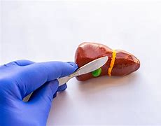 Image result for Open Gallbladder Removal