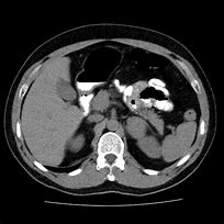 Image result for Pheochromocytoma On CT Scan