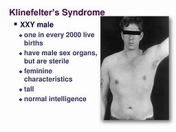 Image result for Klinefelter's Syndrome