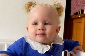 Image result for Albino Child