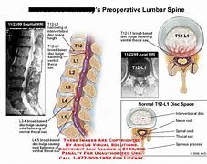 Image result for T12-L1 Back Pain