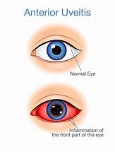 Image result for Uveitis Vision