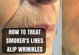 Image result for Upper Lip Wrinkles