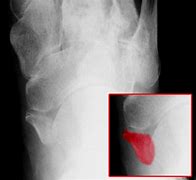 Image result for OS Tibiale Externum