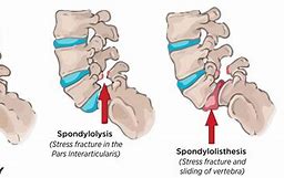 Image result for Pars Defect Lumbar Spine