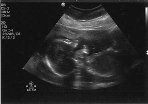 Image result for Baby Sonogram