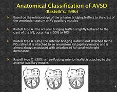 Image result for Atrioventricular Canal Defect Osmosis