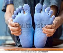 Image result for Cyanosis Legs