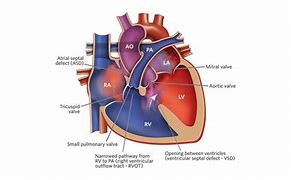 Image result for Tof with Atrioventricular Canal Defect