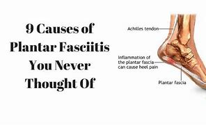 Image result for plantar fasciitis causes