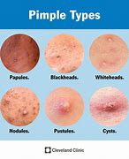 Image result for Alot of Pimples Black