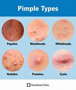 Image result for People with Pimples