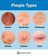 Image result for Deep Acne Cyst