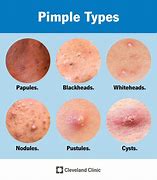 Image result for Pimple Black Spot