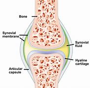 Image result for Inflammed Synovial Tissue