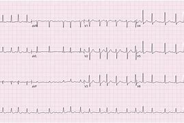 Image result for Atrial Fibrillation On the Body