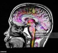 Image result for Diffusion MRI