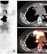 Image result for Hodgkin Lymphoma PET/CT