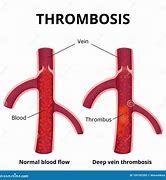 Image result for What Is a Thrombus