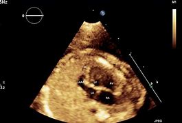 Image result for Right Atrial Appendage Fetal Echo