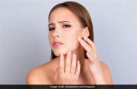 Image result for Acne Scars Home Remedy