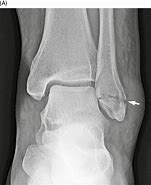 Image result for Lateral Malleolus Fracture Splint