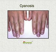 Image result for Cyanosis