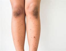 Image result for Dark Age Spots On Legs