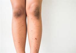 Image result for Skin Darkening Legs