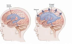 Image result for Hydrocephalus