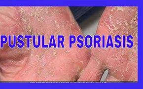 Image result for Psoriatic Pustules