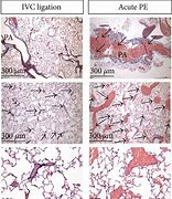 Image result for IVC Thrombs Post-Mortem